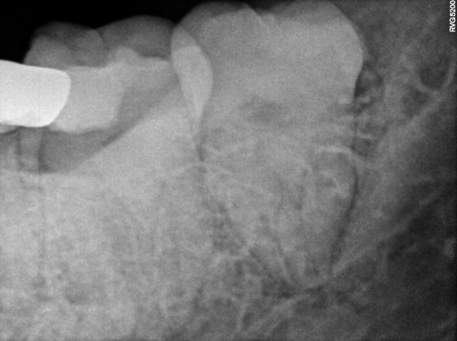 Dental X-ray